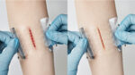 Cierre Cutáneo - Surginus Foldable Skin Closure - Imagen 2