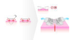 Cierre Cutáneo - Surginus Foldable Skin Closure - Imagen 3